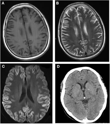 Could Sporadic Creutzfeldt-Jakob Disease Be Underdiagnosed in China? Experience From Four Cases